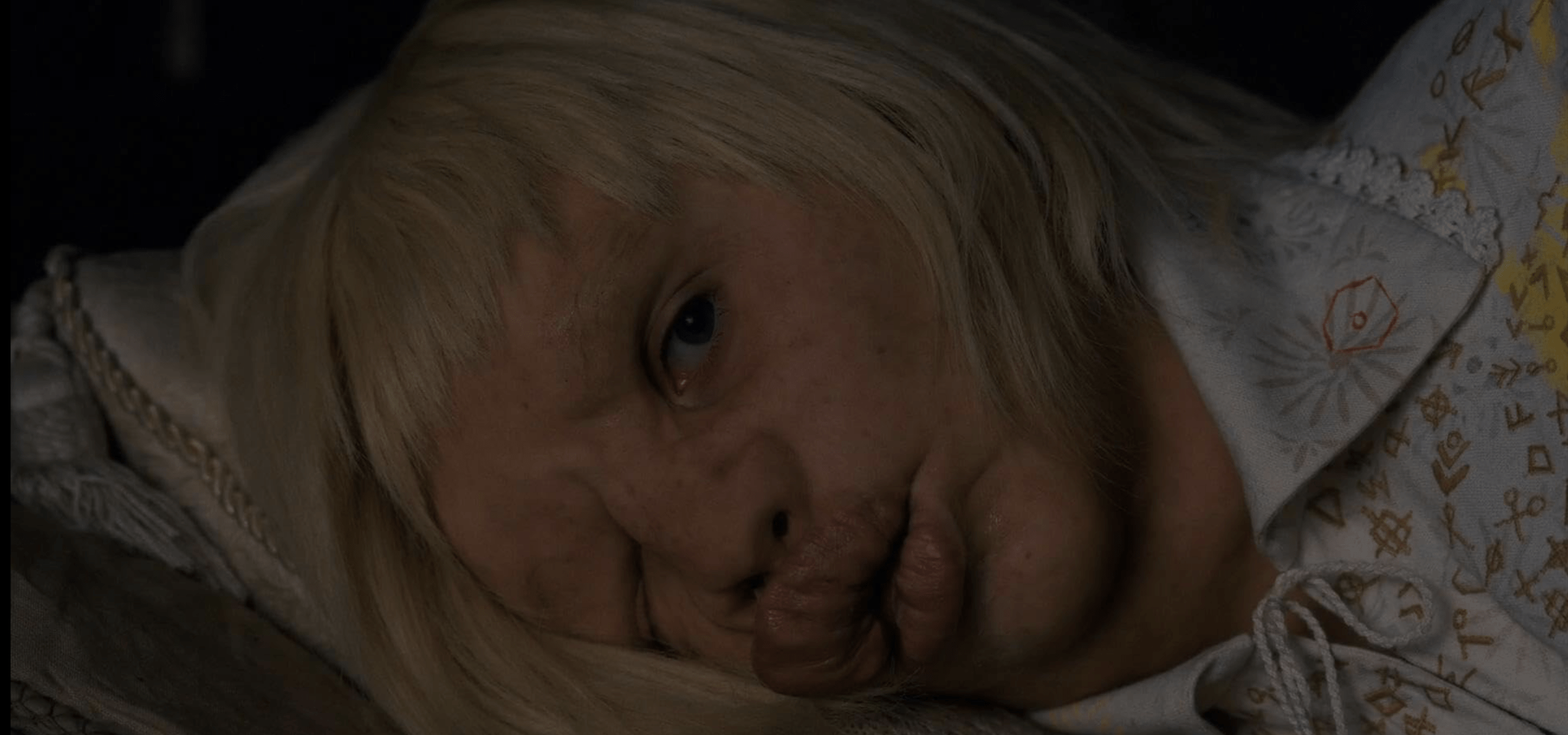 A disfigured blonde boy lies down
